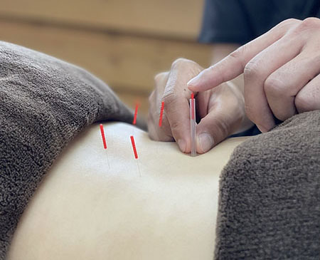 鍼灸治療
